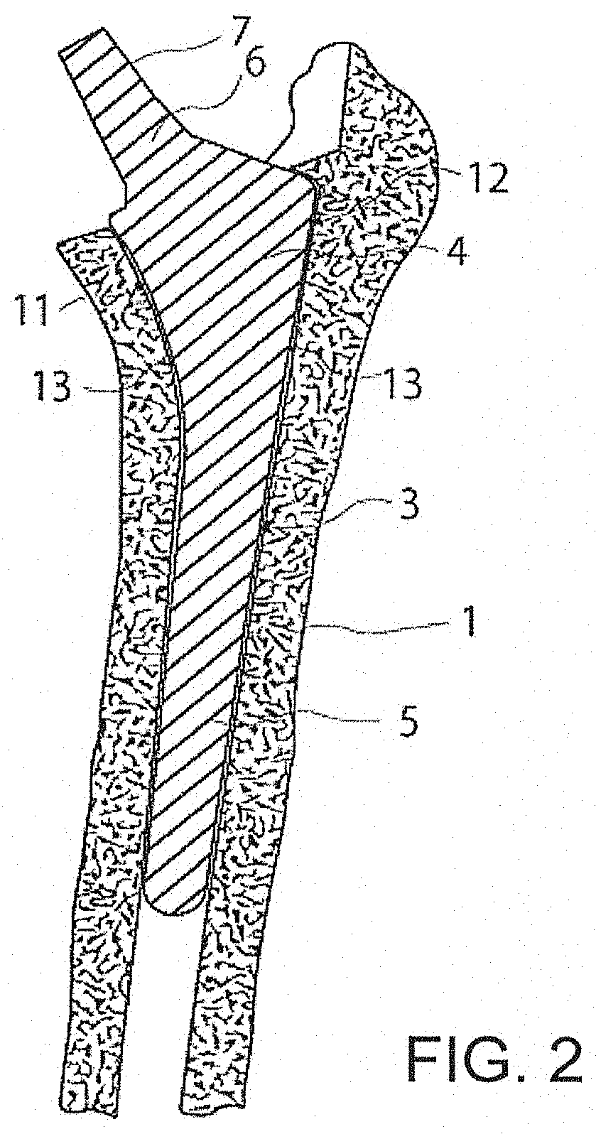 Thin-blade chisel system