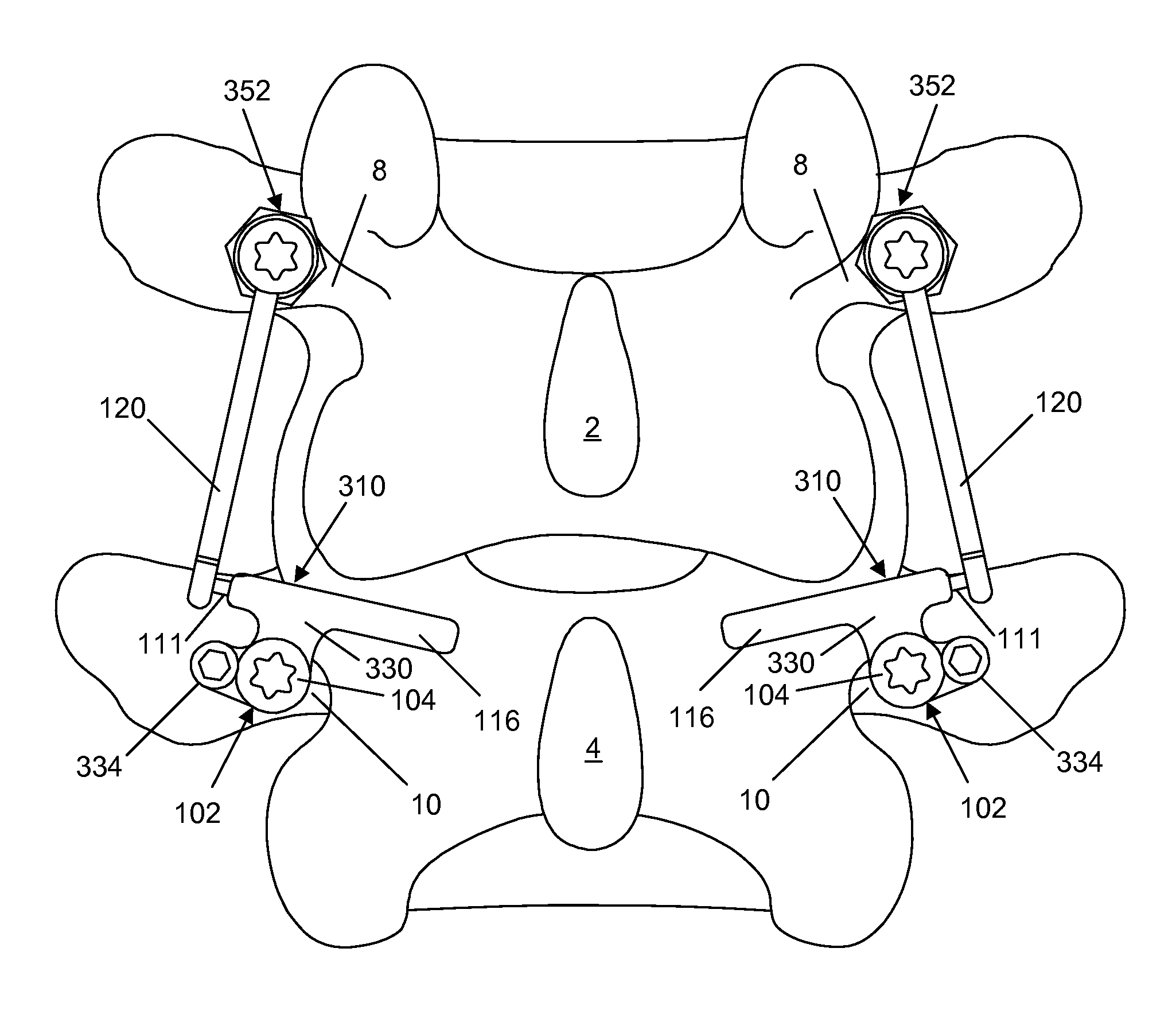 Spine implant with a defelction rod system anchored to a bone anchor and method