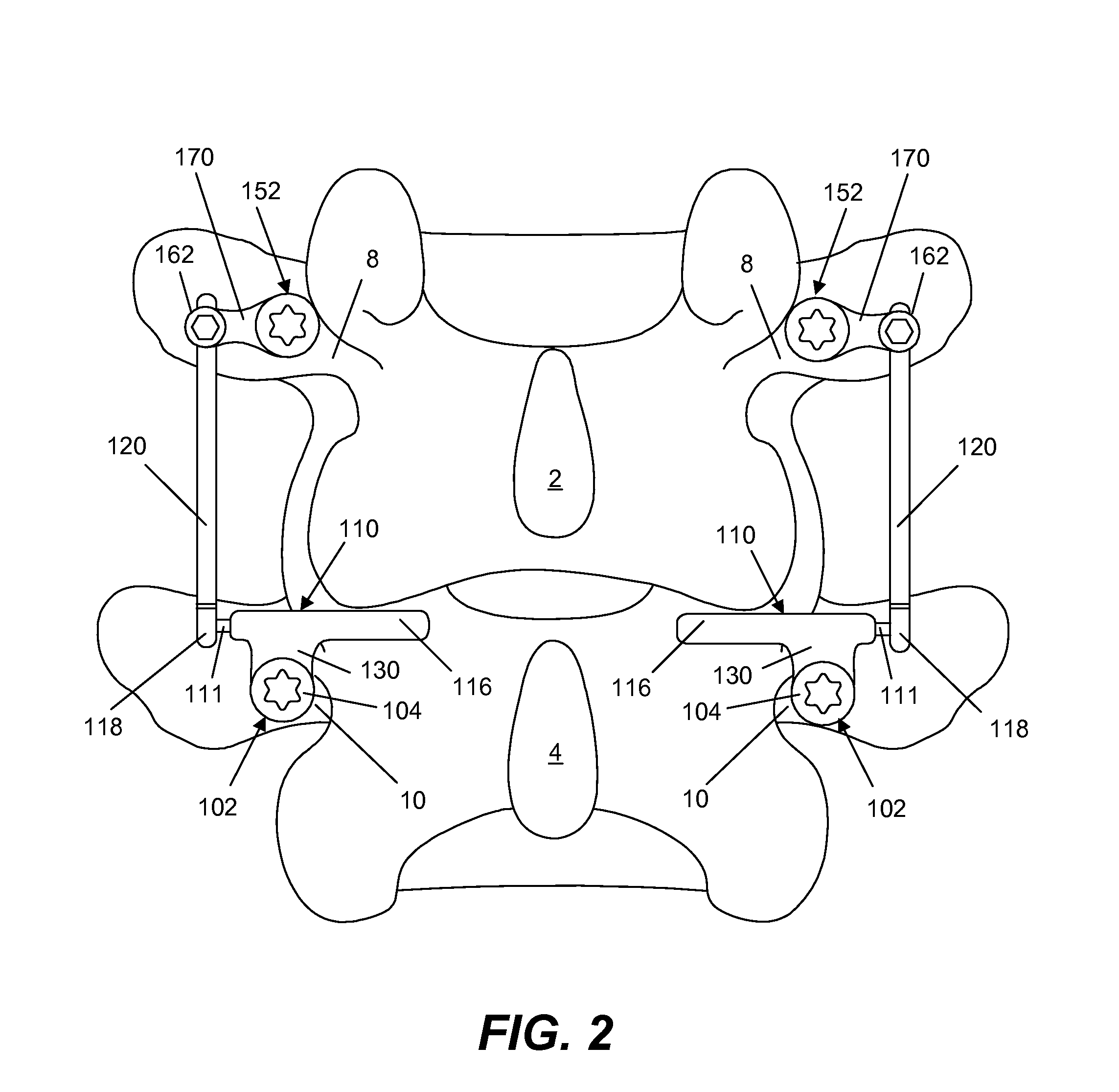 Spine implant with a defelction rod system anchored to a bone anchor and method