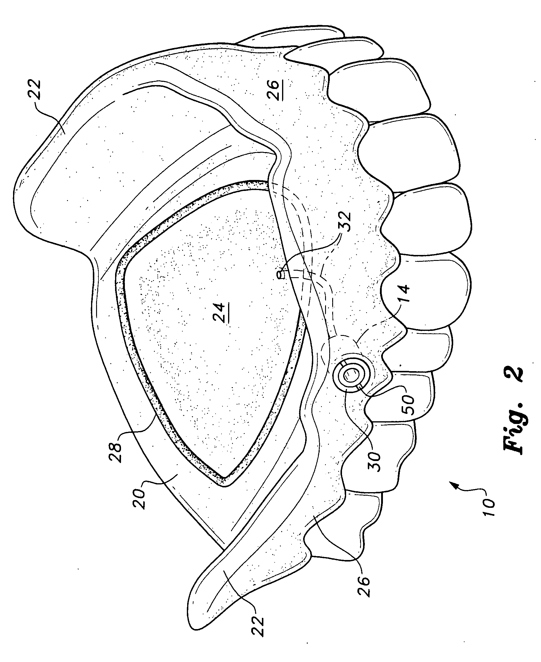 Denture with suction attachment