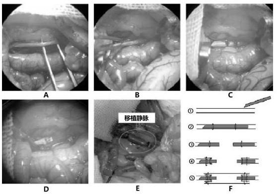 Animal model construction method for transplanted vein restenosis research