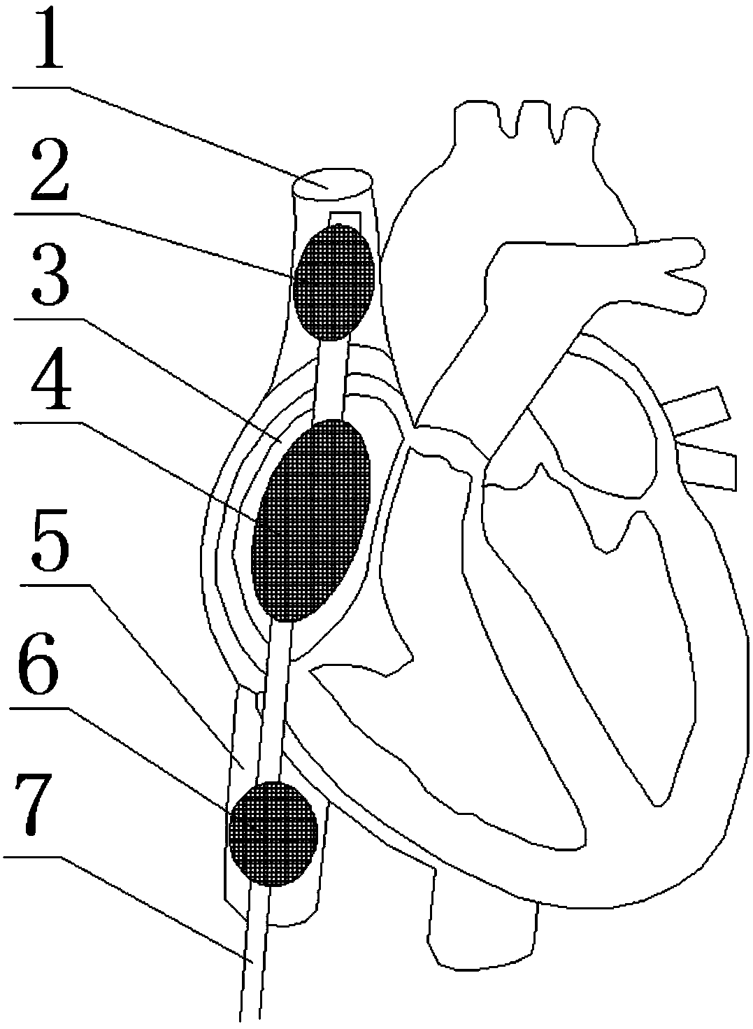 Venous cardiac assist device and interventional therapy equipment applying same