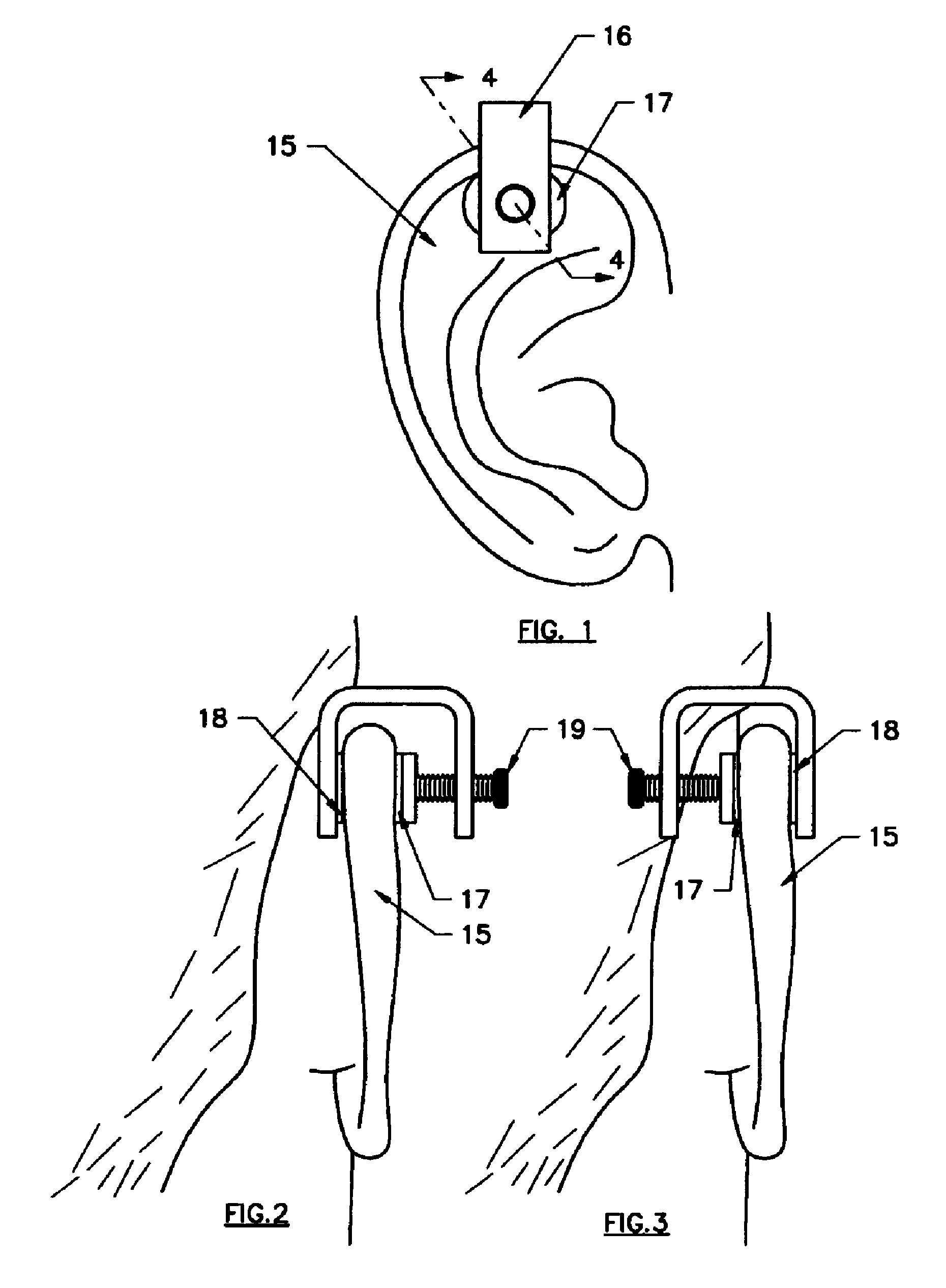Device and Method for Treating Ear Injuries