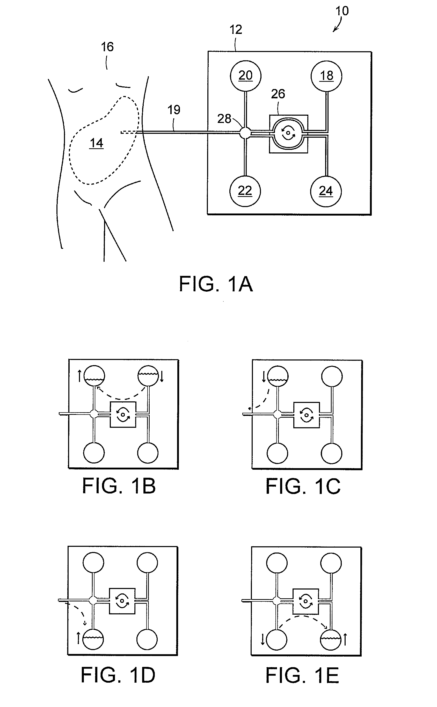 Apparatus and methods for early stage peritonitis detection and for in vivo testing of bodily fluid