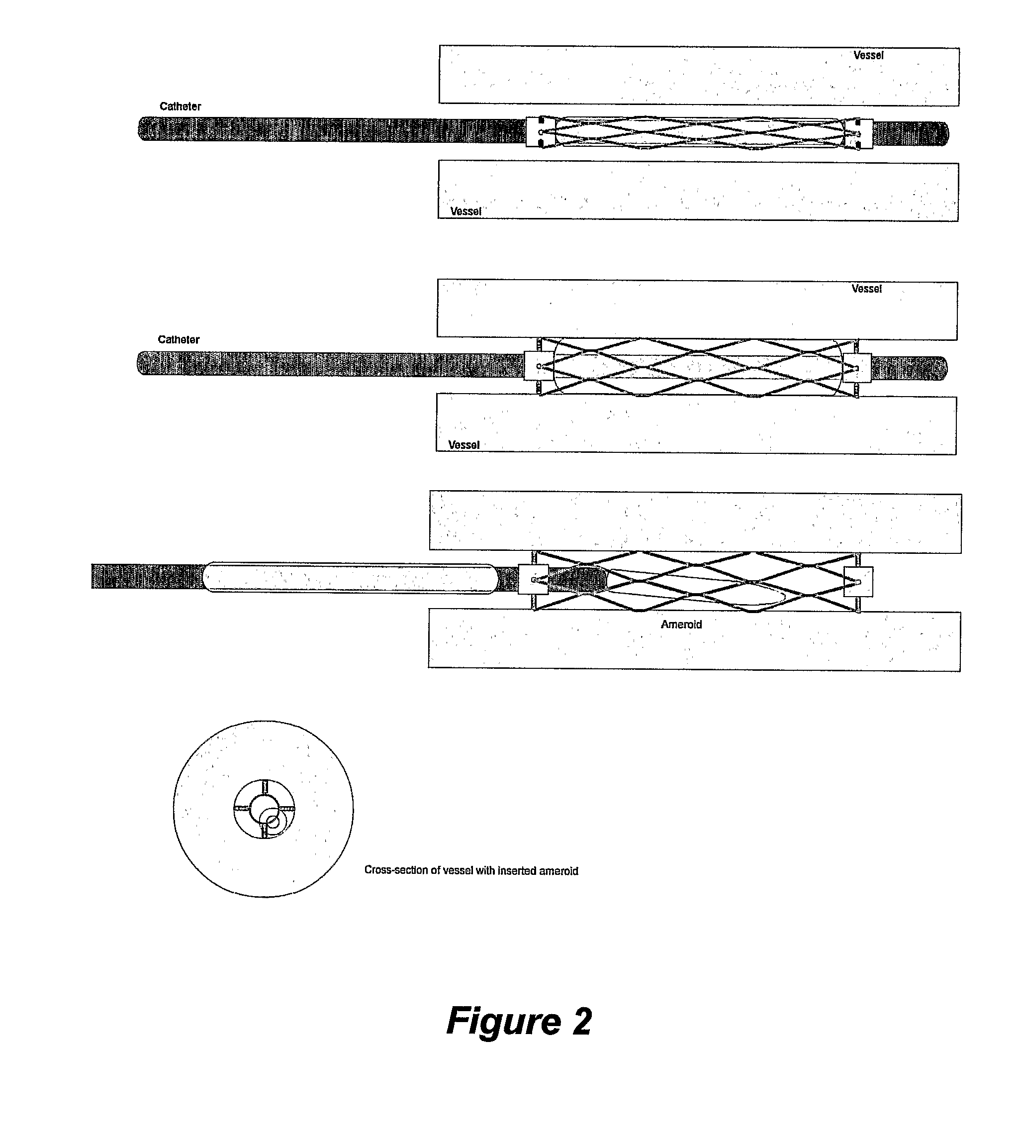 Devices, Systems and Methods for Controlling Local Blood Pressure