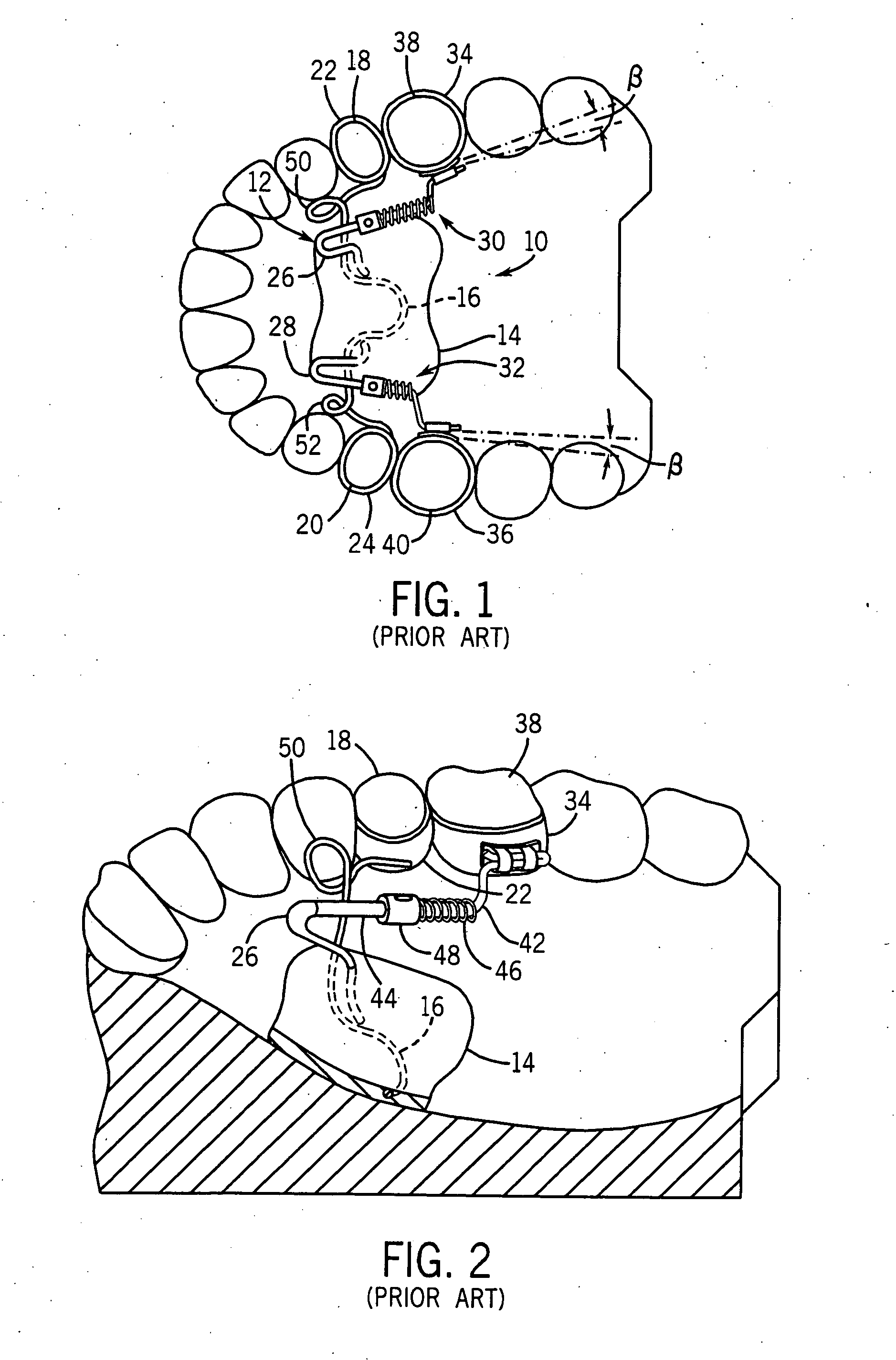 Orthodontic distalizing apparatus