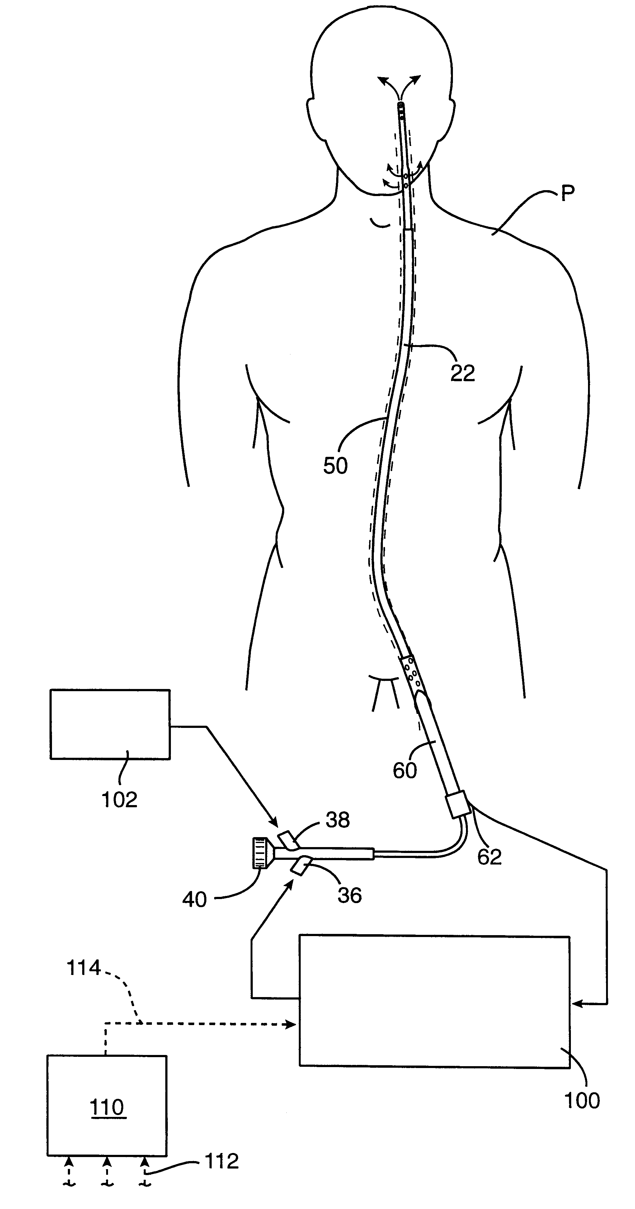Methods and systems for treating ischemia
