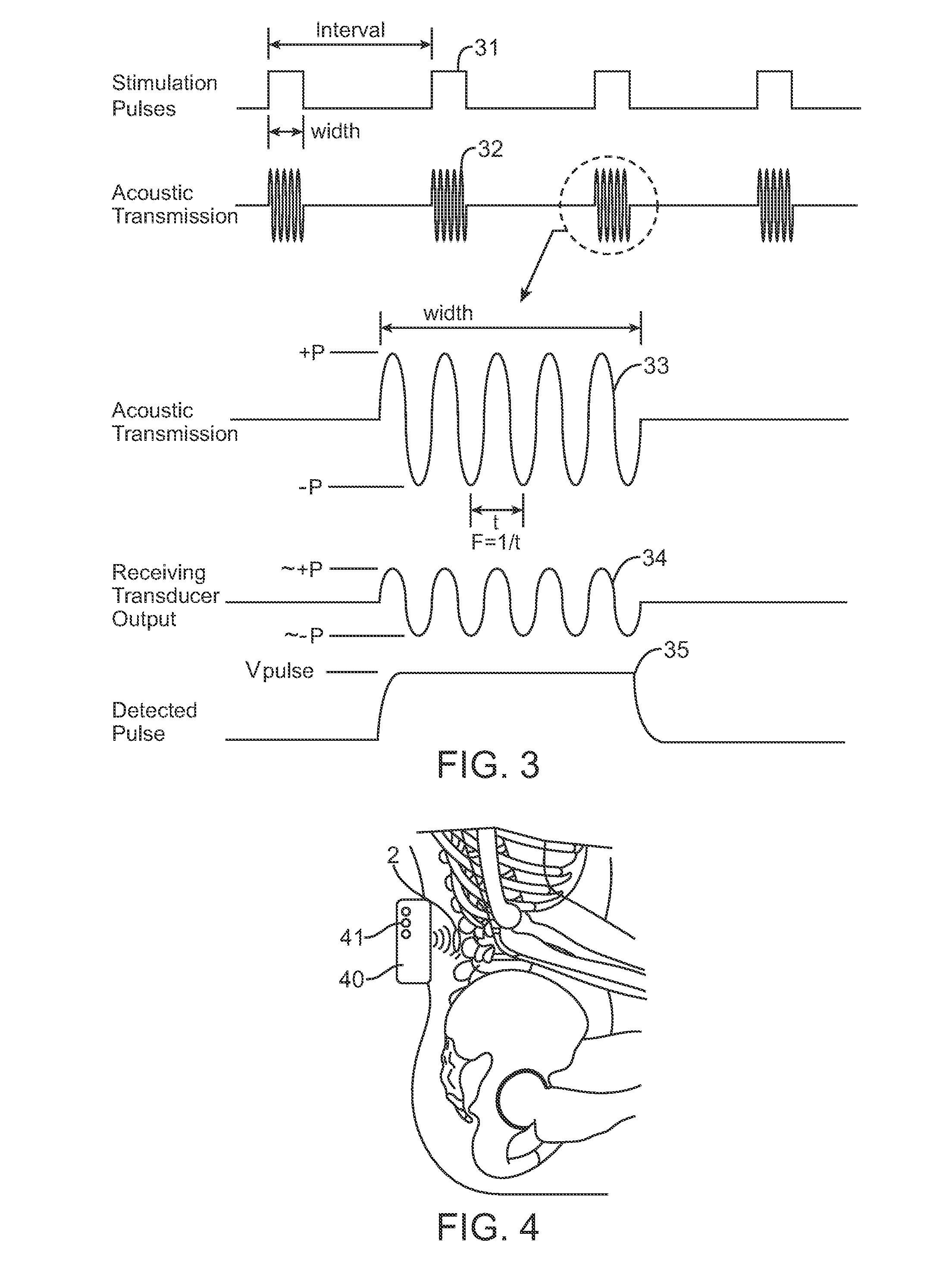 Systems and methods for implantable leadless bone stimulation