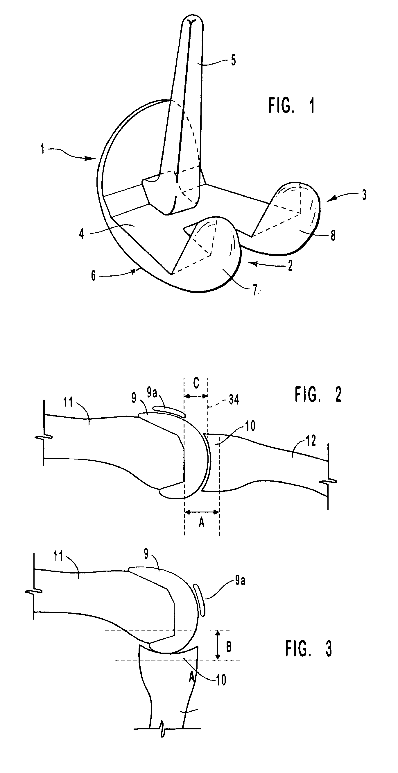 Method for resecting the knee using a resection guide and provisional prosthetic component