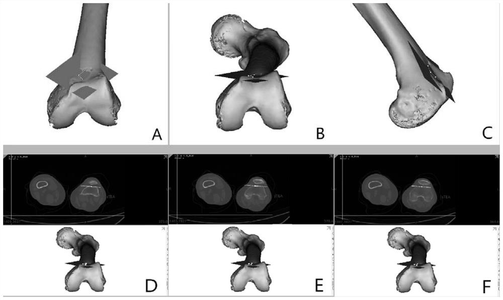 Reference system for rotational positioning of femoral prosthesis