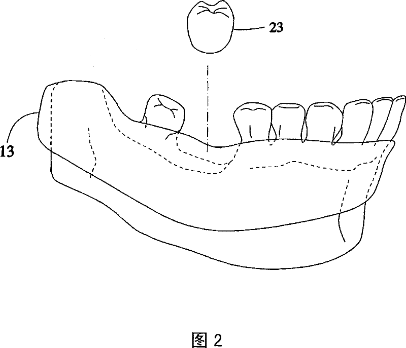 Digital supporting tooth design method by digital tooth implantation technology
