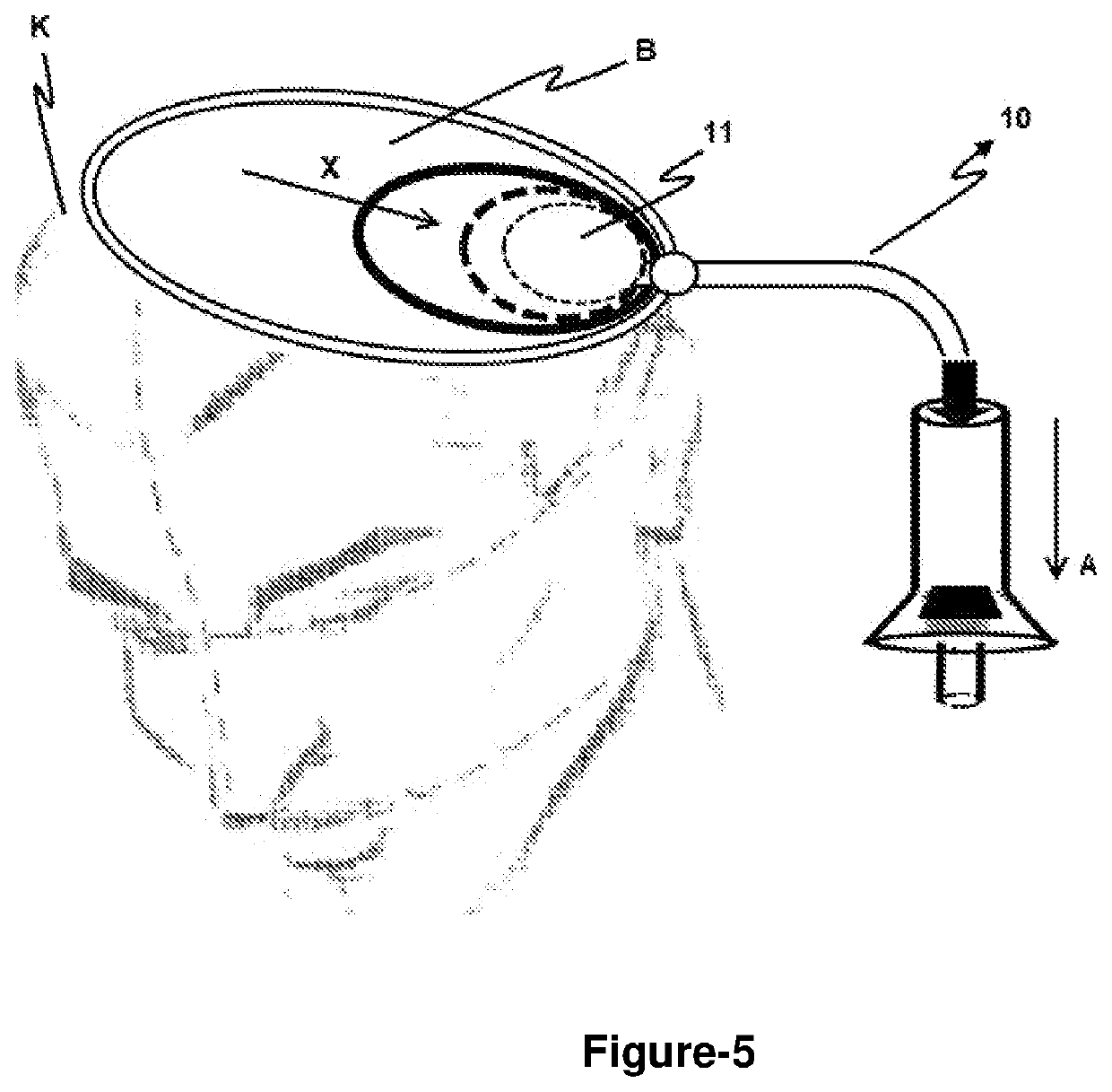 Pressure-regulated balloon apparatus positioned in the cavity formed in the brain after surgery