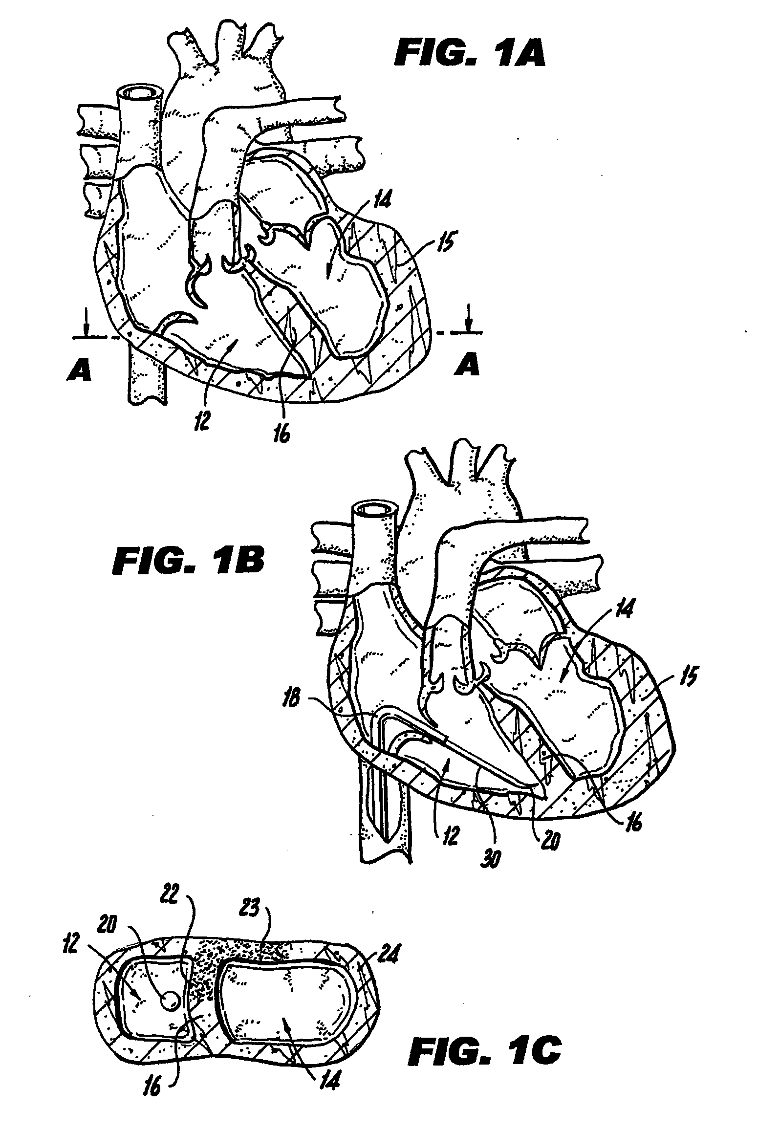 Method and device for percutaneous left ventricular reconstruction