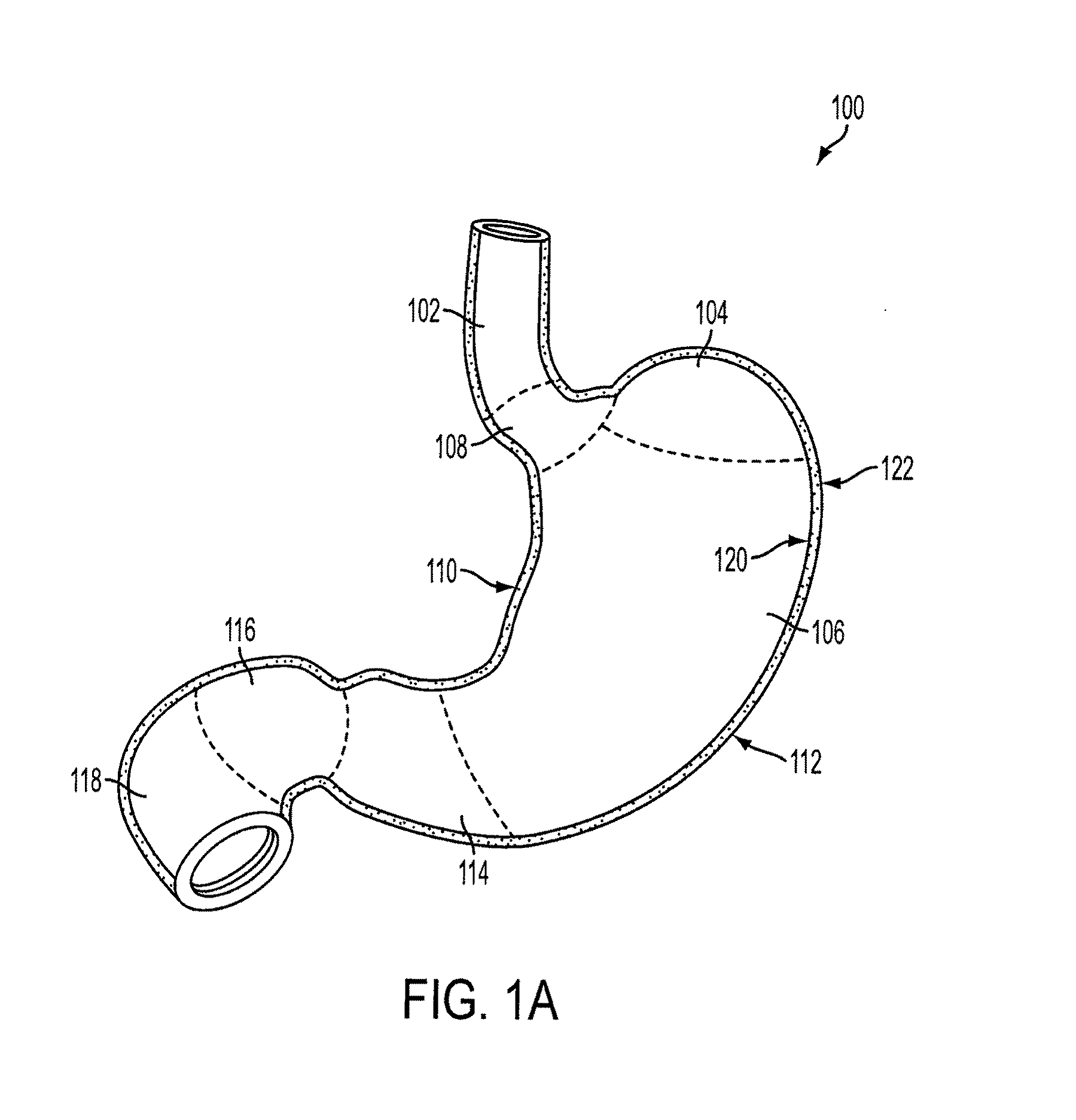 Method and apparatus for gastric restriction of the stomach to treat obesity