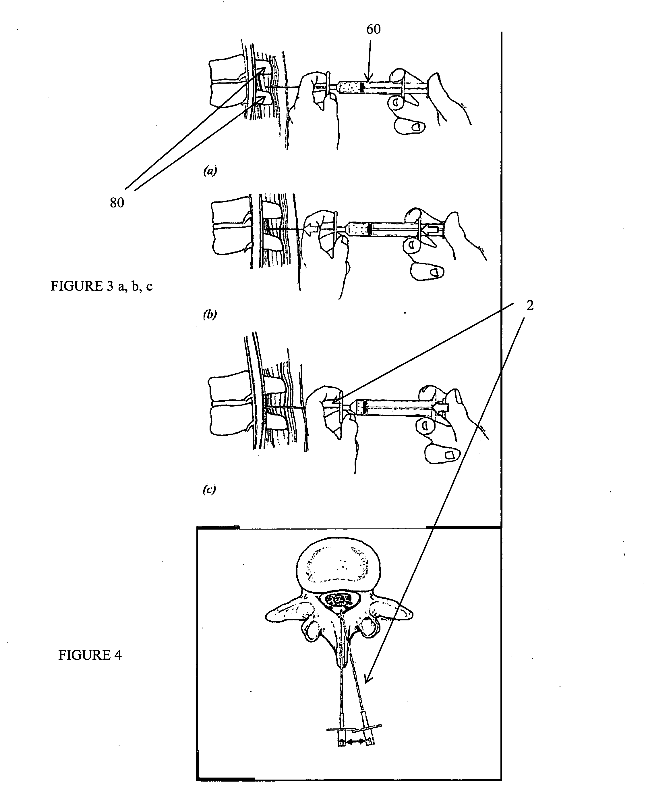 Devices and methods for tissue access