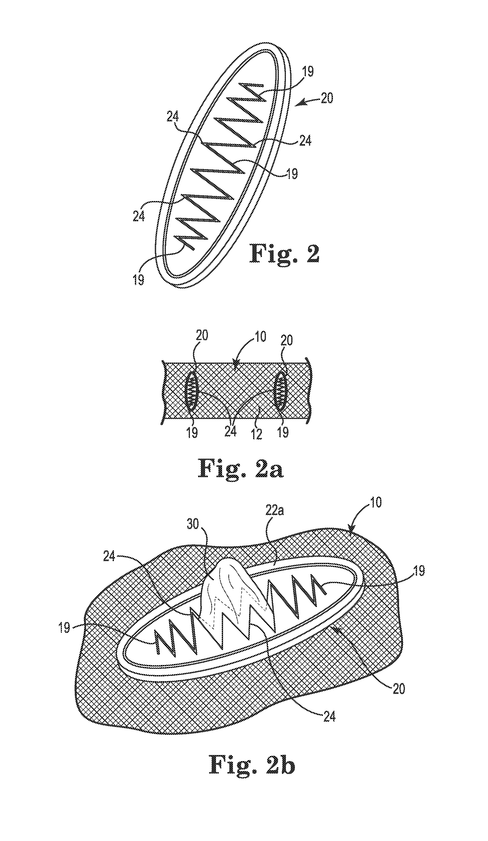 Implant Tissue Fixation System and Method
