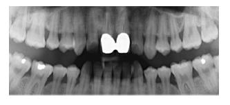 Method for repairing images in dental implanting navigation