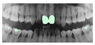 Method for repairing images in dental implanting navigation