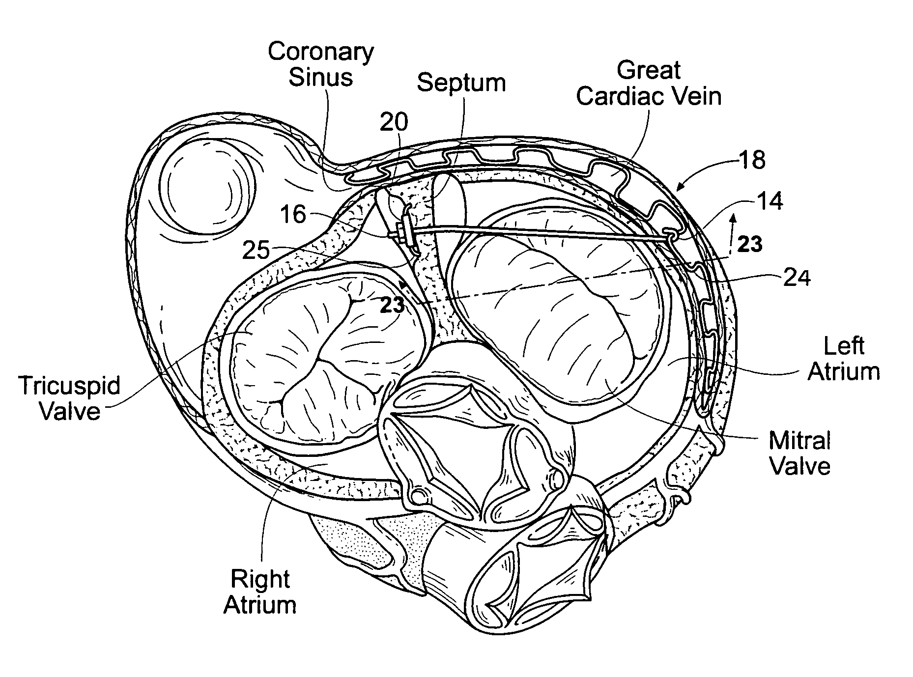 Methods for reshaping a heart valve annulus using a tensioning implant