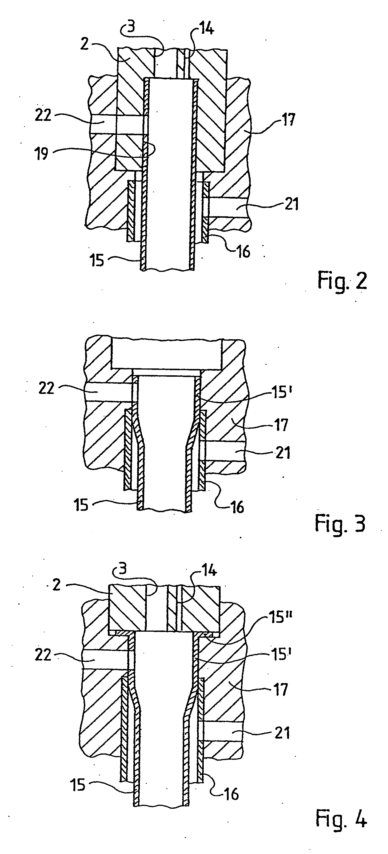 Removable resectoscope provided with an external shaft
