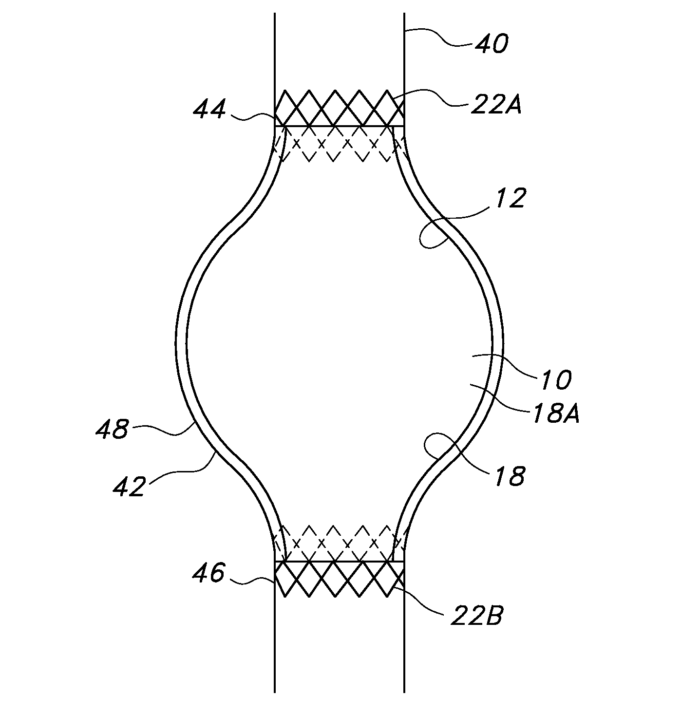 Sac liner for aneurysm repair