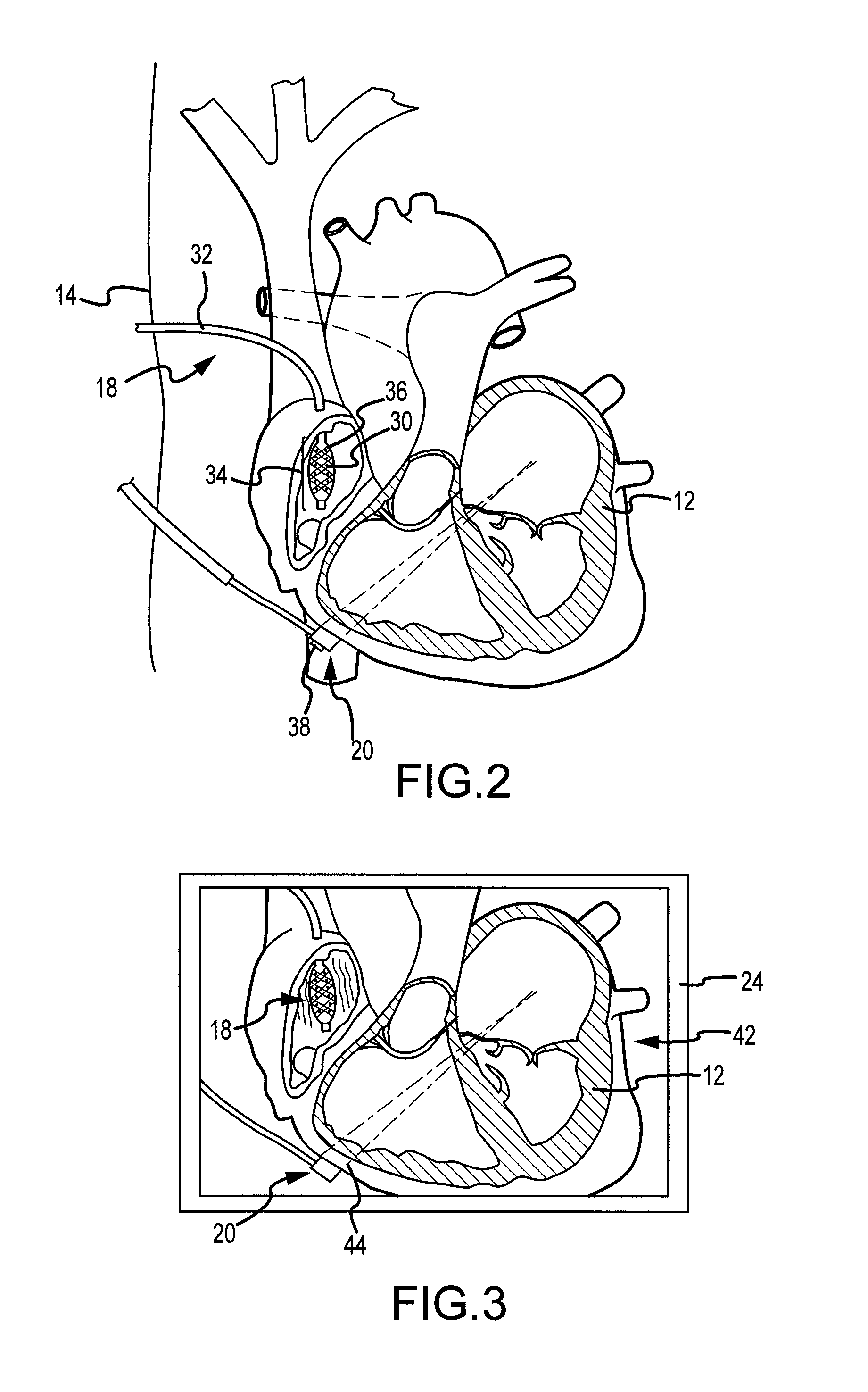 System for displaying data relating to energy emitting treatment devices together with electrophysiological mapping data