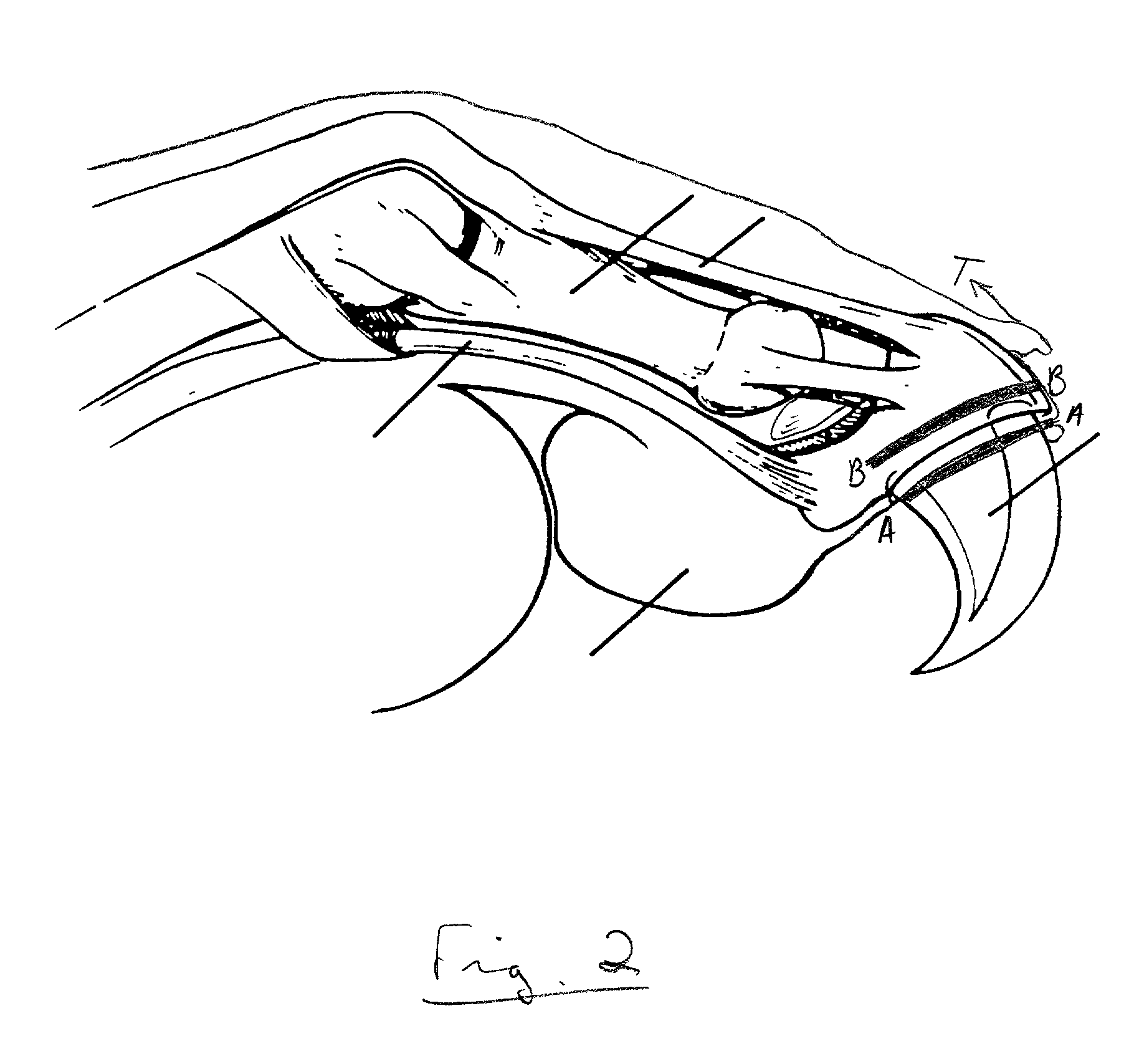 Laser onychectomy by resection of the redundant epithelium of the ungual crest