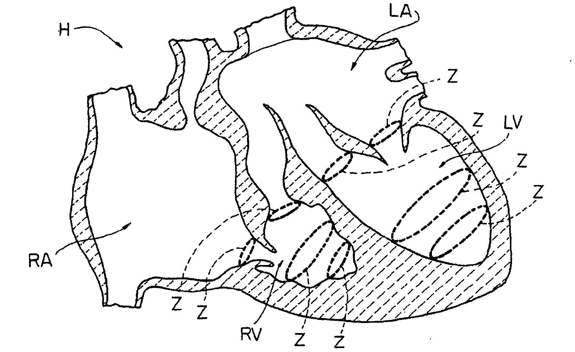 Intracardiac device for restoring the functional elasticity of the cardiac structures, holding tool for the intracardiac device, and method for implantation of the intracardiac device in the heart