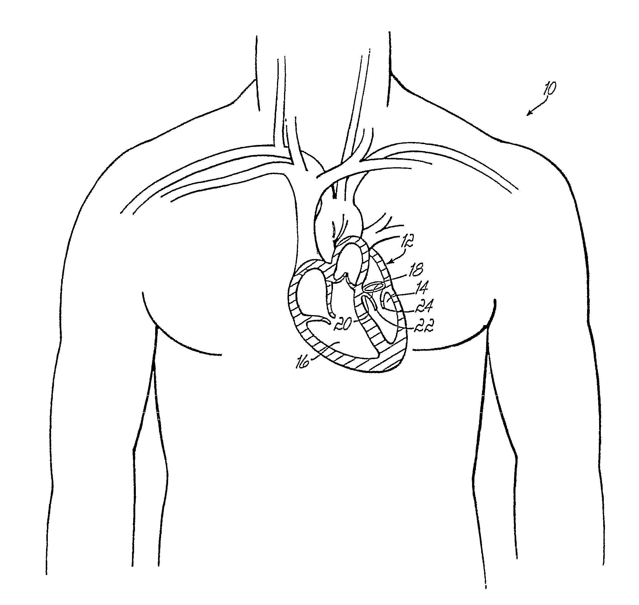Device And Method For Improving The Function Of A Heart Valve
