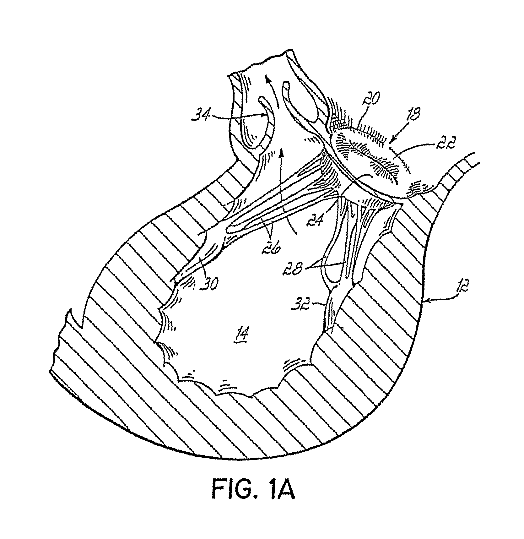 Device And Method For Improving The Function Of A Heart Valve
