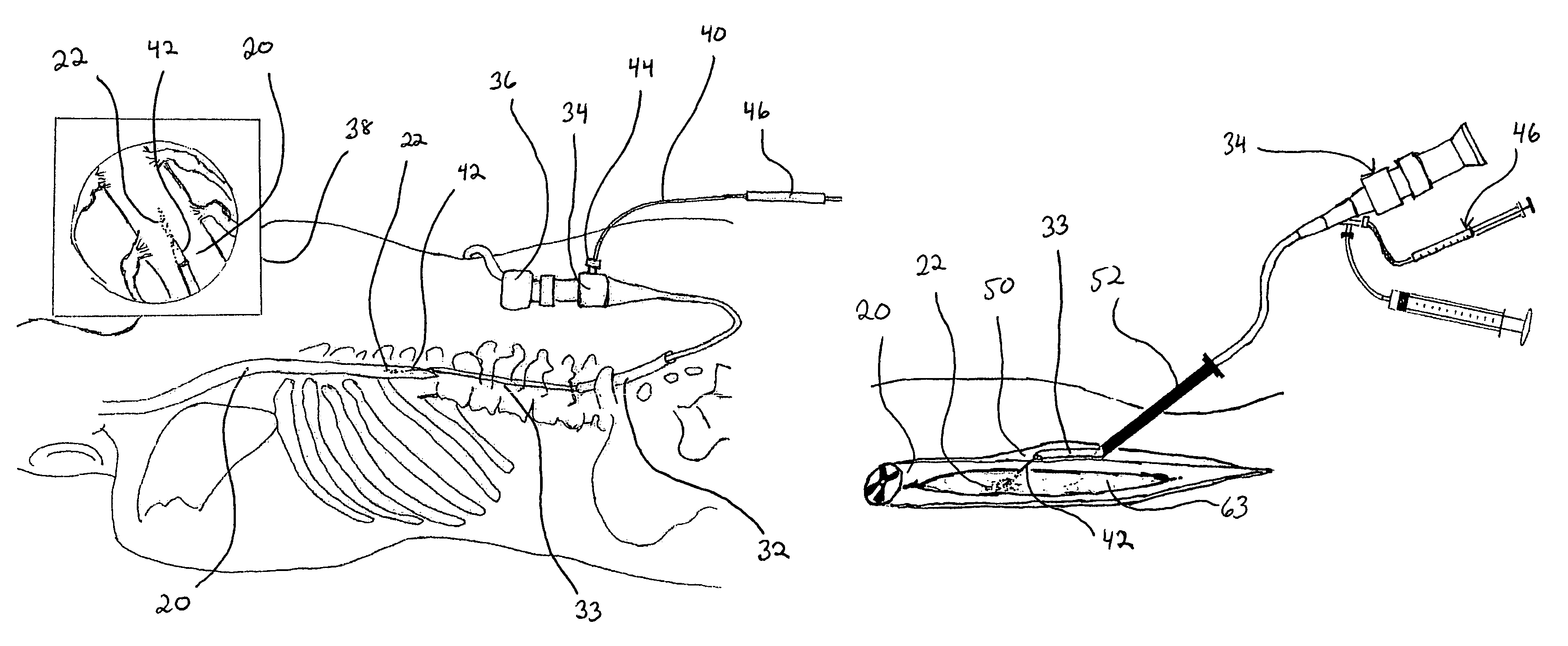 Method and system for cellular transplantation in the spinal cord