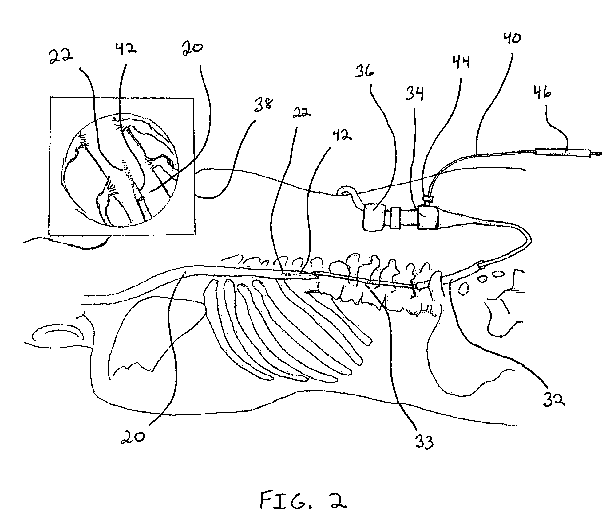 Method and system for cellular transplantation in the spinal cord