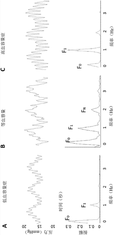 Hypovolemia/hypervolemia detection using peripheral intravenous waveform analysis (PIVA) and applications of same