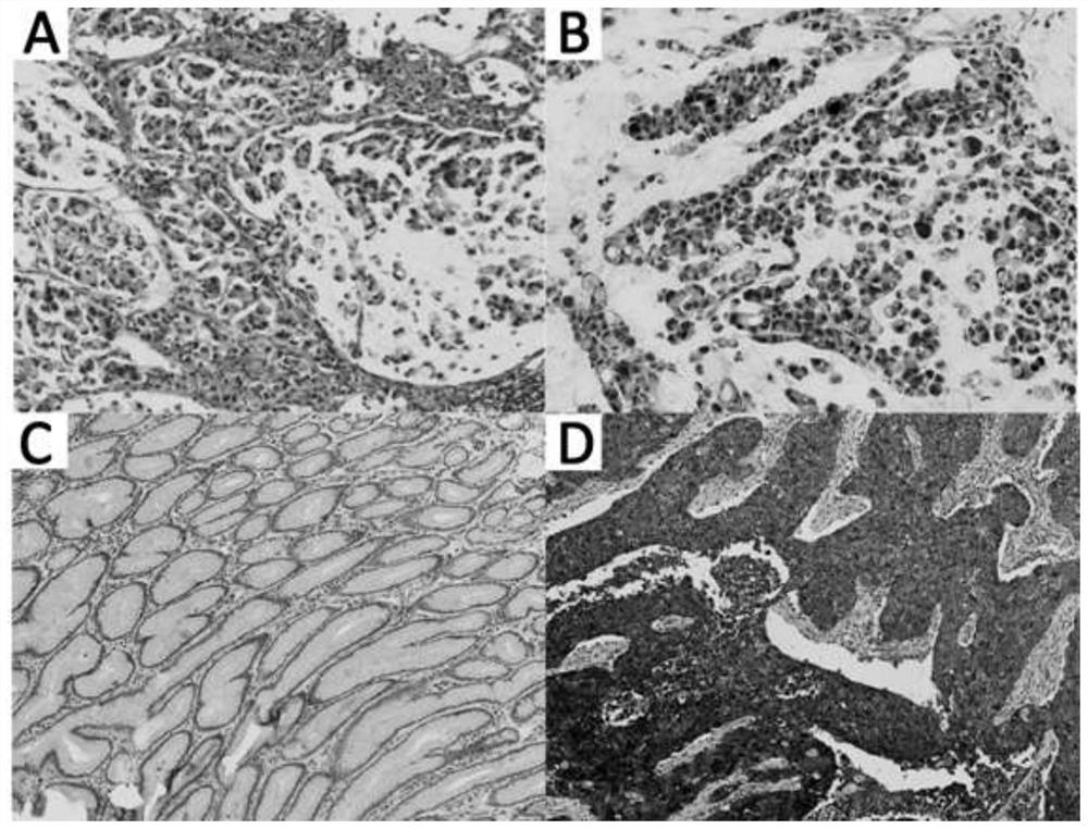 Antibody composition for recognizing cancer stem cell components in gastric poorly differentiated adenocarcinoma and application thereof