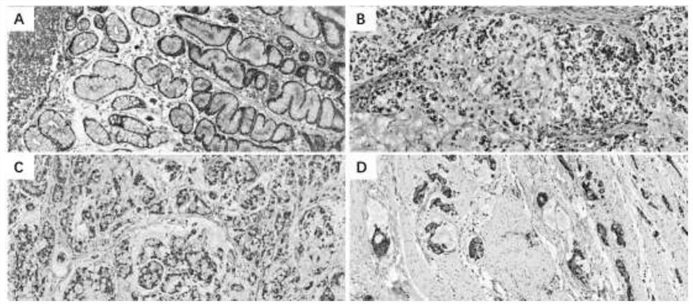 Antibody composition for recognizing cancer stem cell components in gastric poorly differentiated adenocarcinoma and application thereof