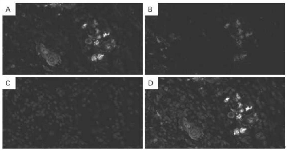 Antibody composition for recognizing cancer stem cell components in gastric poorly differentiated adenocarcinoma and application thereof