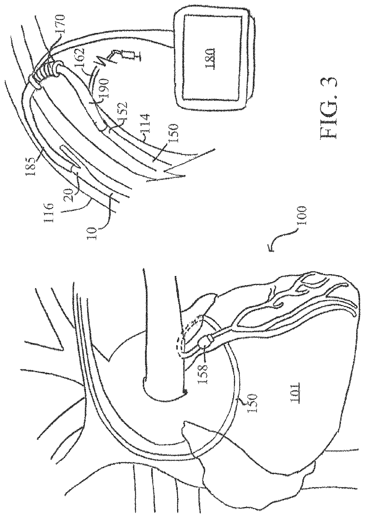 Systems, devices, and methods for organ retroperfusion along with regional mild hypothermia