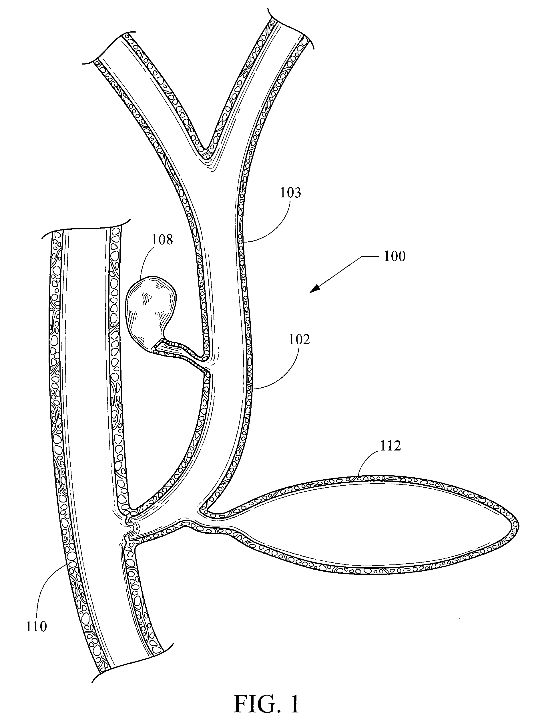 Endoscopic ultrasound-guided stent placement device and method