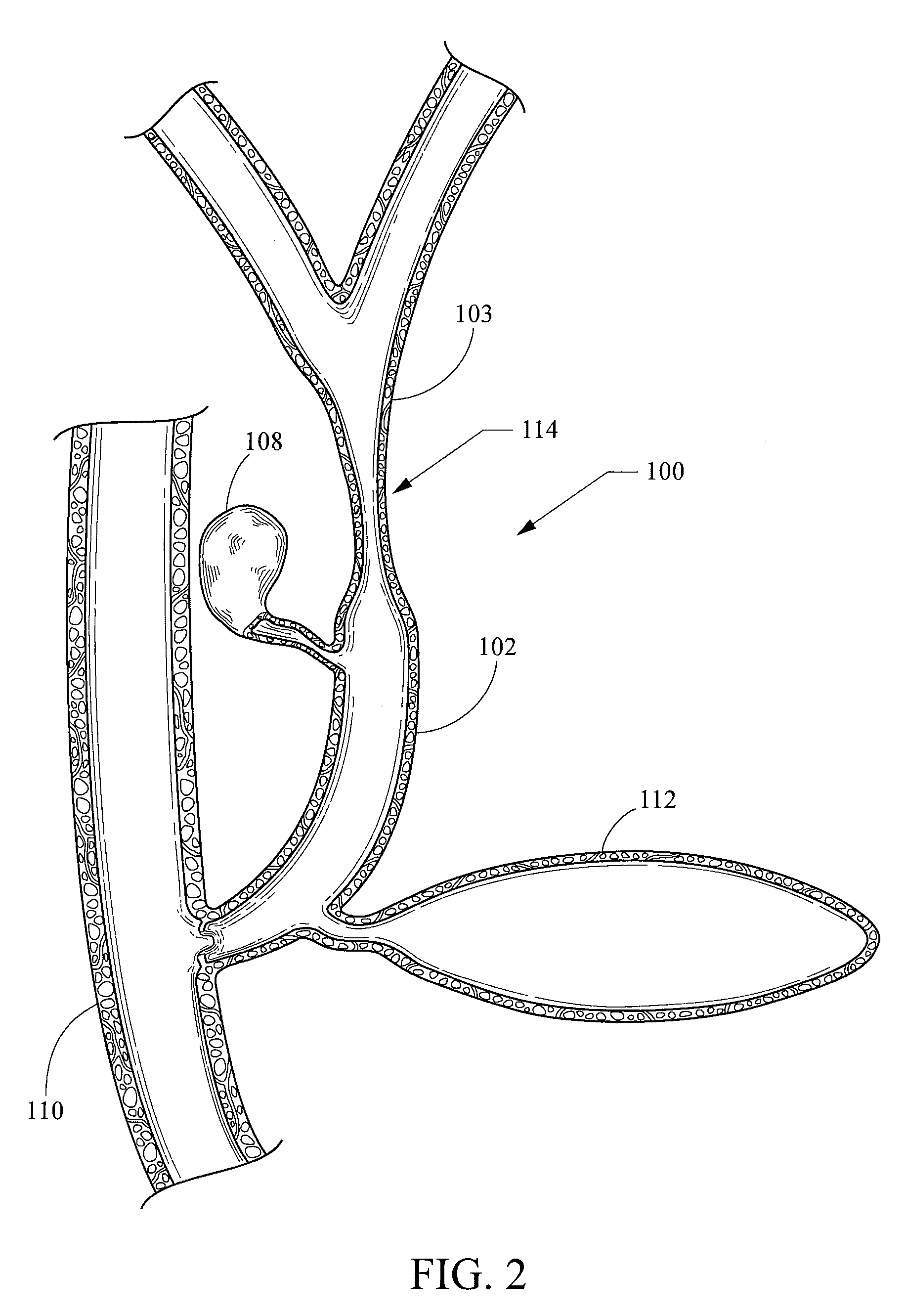 Endoscopic ultrasound-guided stent placement device and method