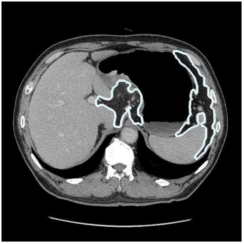Migratory active contour model based stomach CT (computerized tomography) sequence image segmentation method