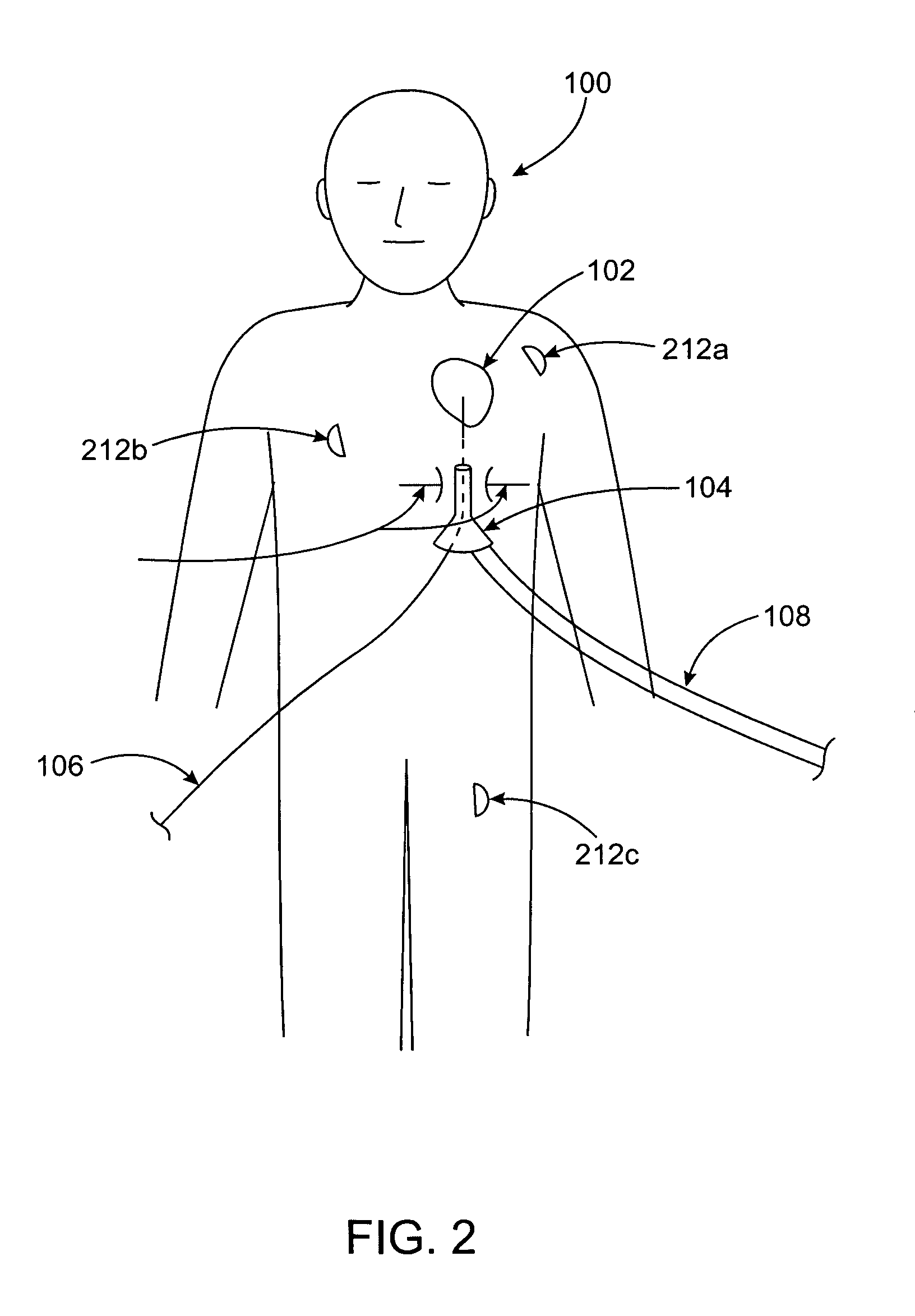 Methods and devices for minimally invasive cardiac surgery for atrial fibrillation