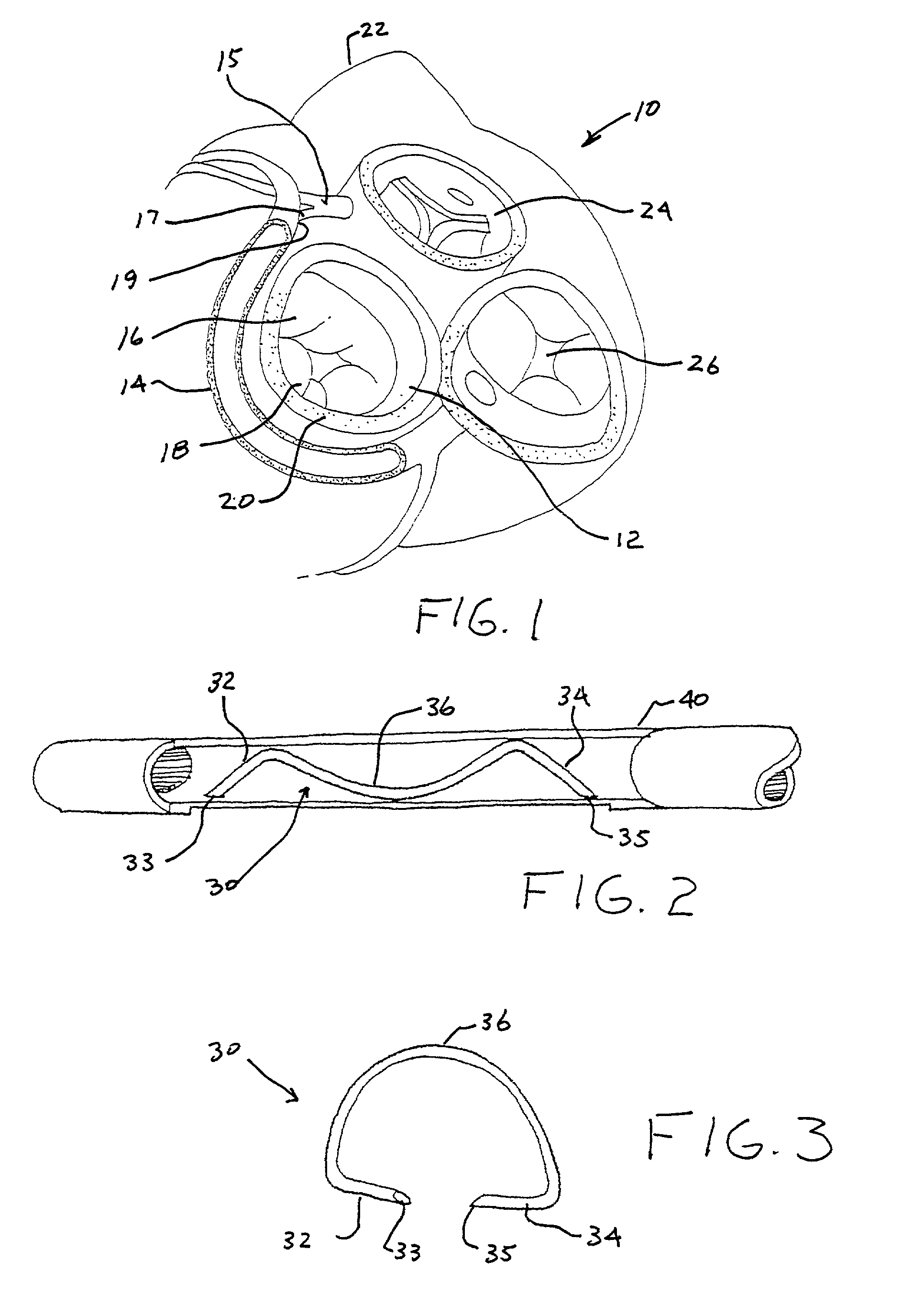Transvenous staples, assembly and method for mitral valve repair