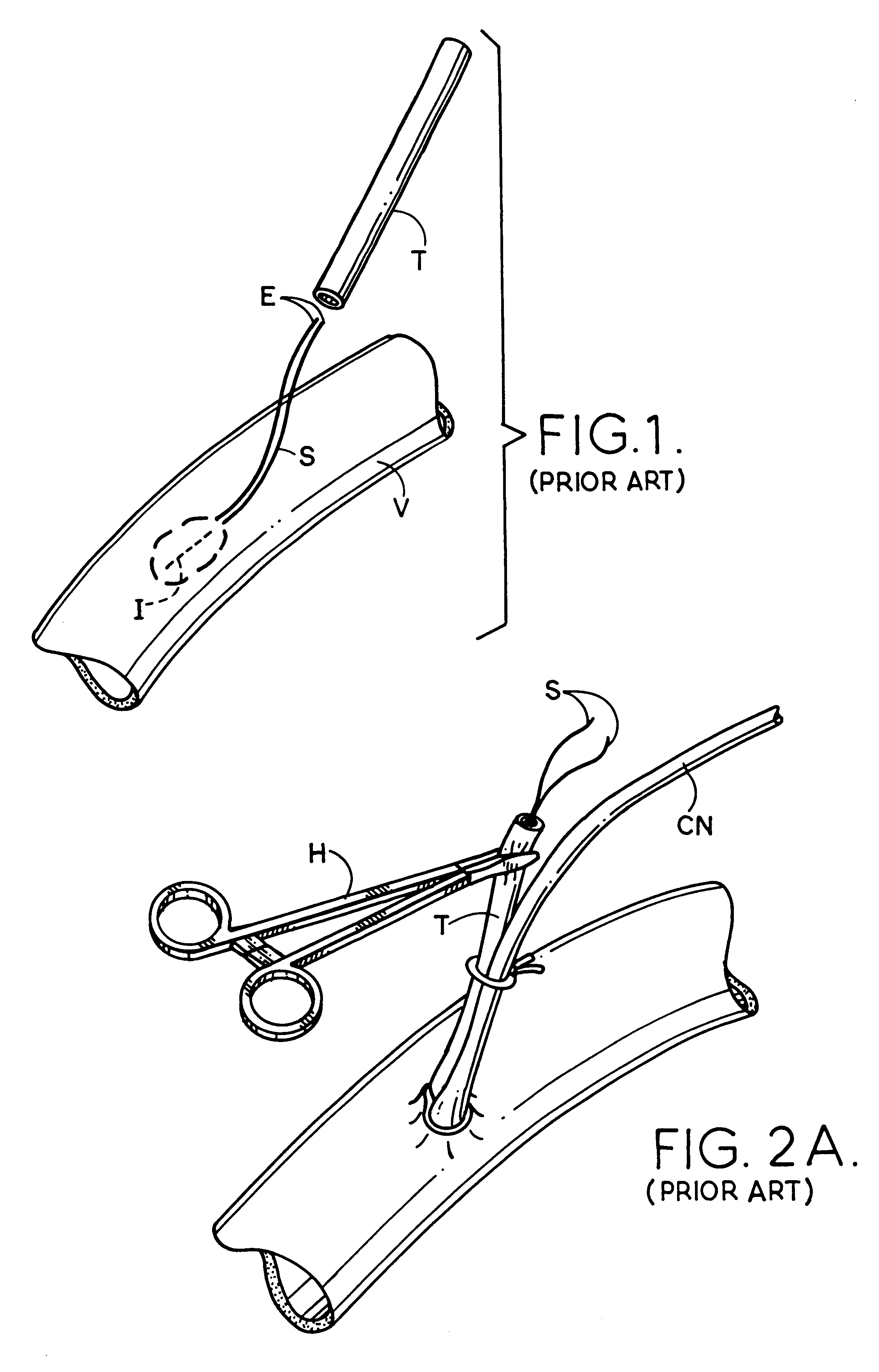 Access and cannulation device and method for rapidly placing same and for rapidly closing same in minimally invasive surgery