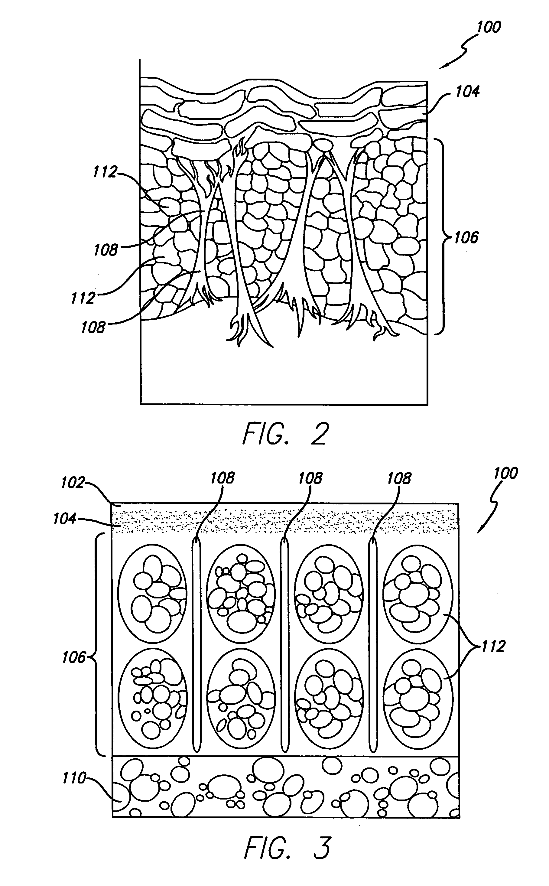 System for treating subcutaneous tissues
