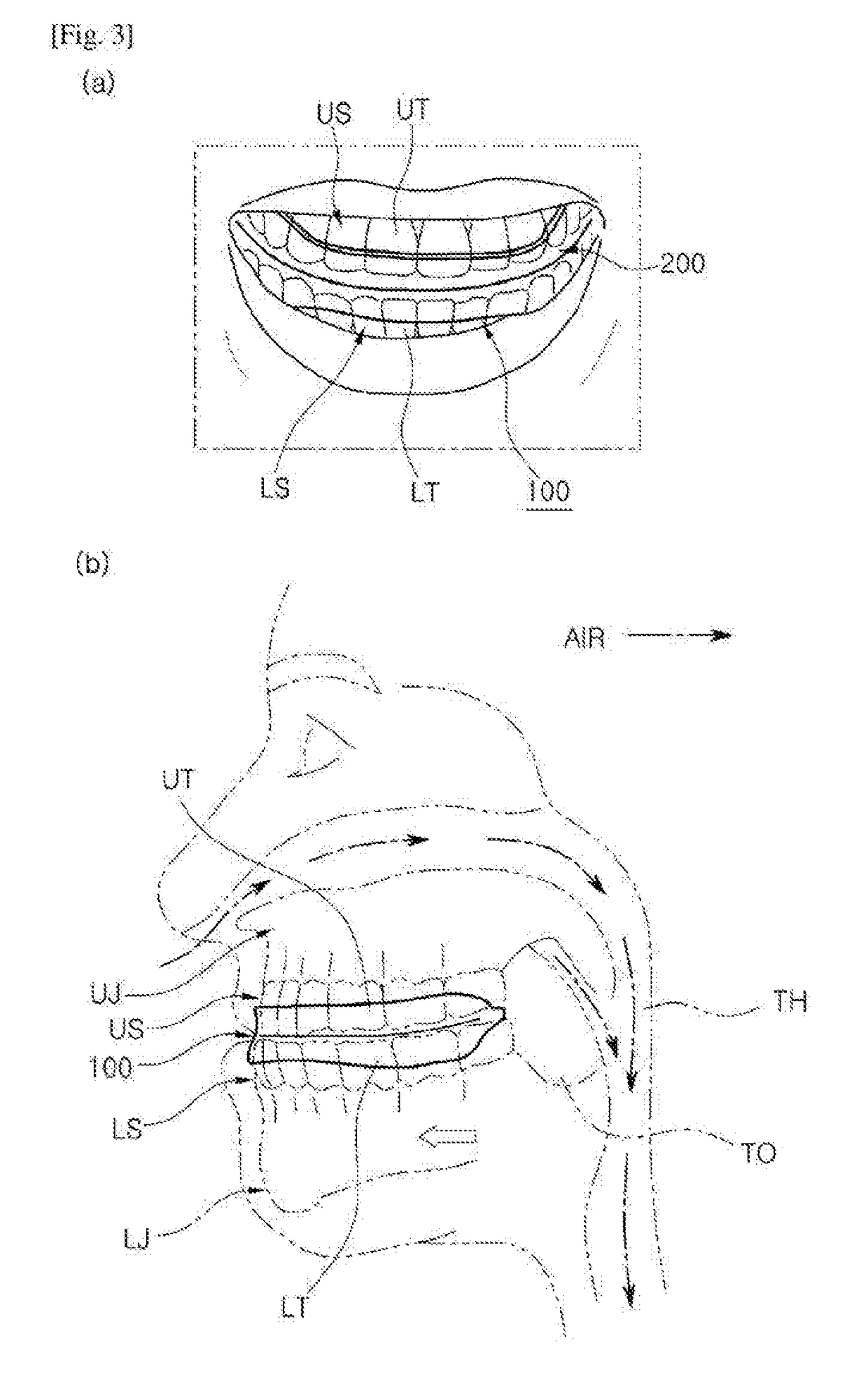 Oral appliance fixed to lower teeth