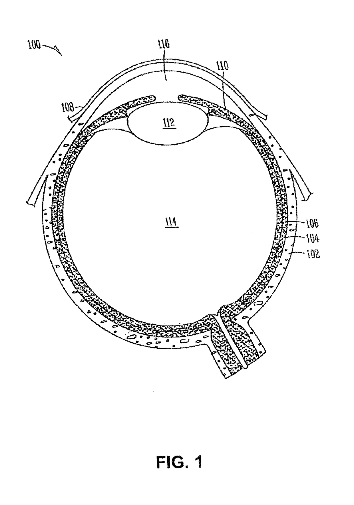 Drug delivery system and methods of treating open angle glaucoma and ocular hypertension
