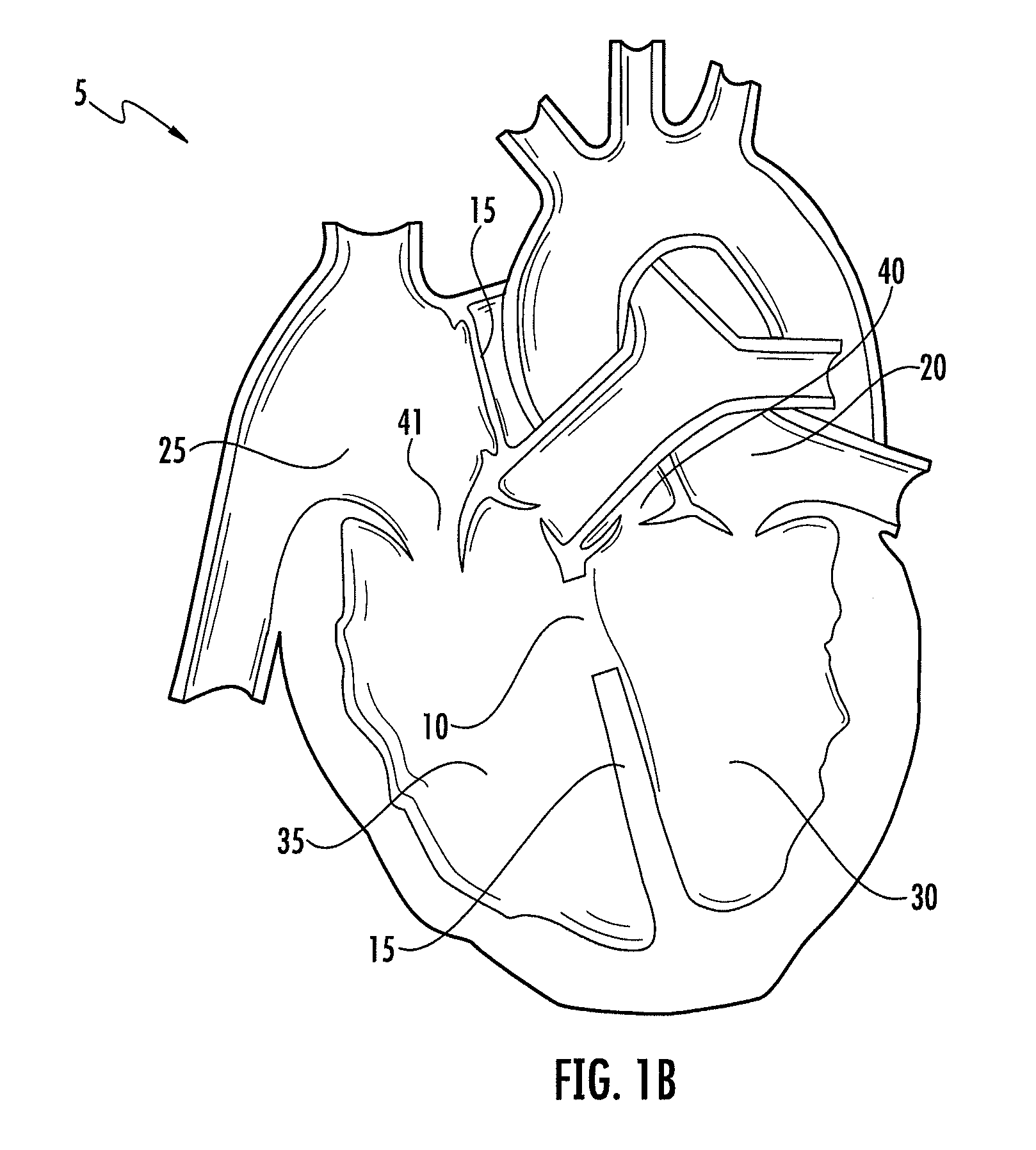 Device and method for occluding a septal defect