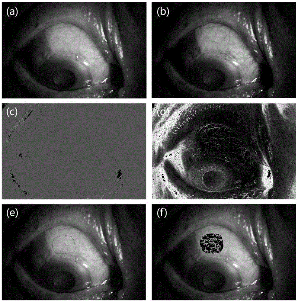 Method for detecting vascularization degree of surface of filtering bleb based on ophthalmic slit lamp photographing
