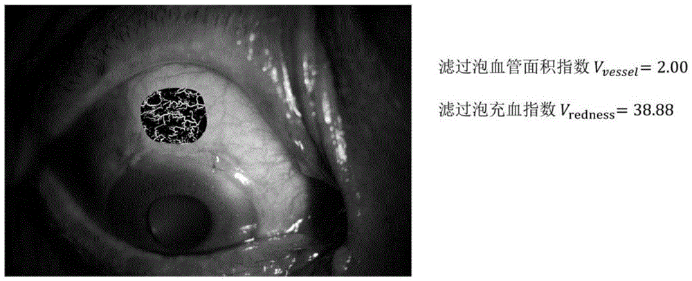 Method for detecting vascularization degree of surface of filtering bleb based on ophthalmic slit lamp photographing