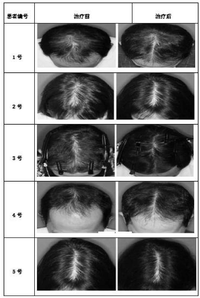 Hair growth injection solution based on autologous fat stem cell exosome, and preparation method